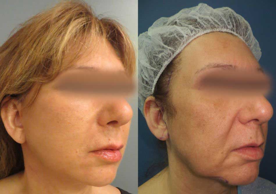 תמונה לפני ואחרי ניתוח מתיחת פנים